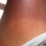 10 Minutes in the #sun... #Leg #Tanningline #Spain #Benidorm #NoFilter